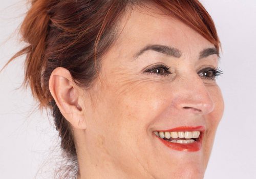 Lachrimpels Botox behandeling met Azzalure resultaat