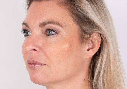 Lip fillers - hoge jukbeenderen