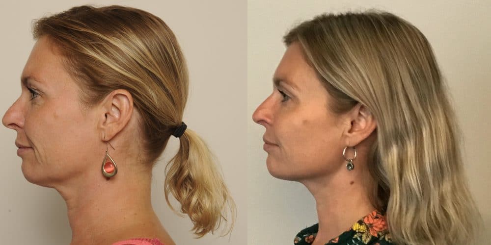 Resultaat behandeling kin-fillers