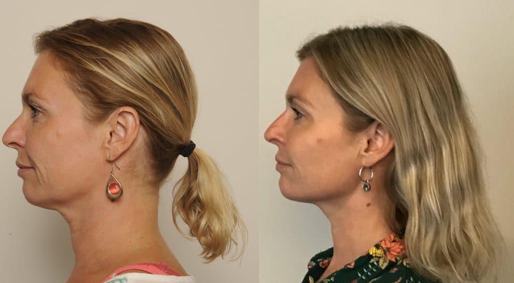 Resultaat behandeling kin-fillers