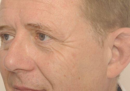 Resultaat ooglidcorrectie Jan - links