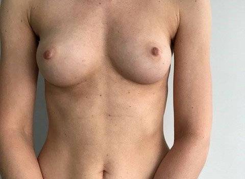 Borstvergroting met eigen vet na, Lipofilling borsten na