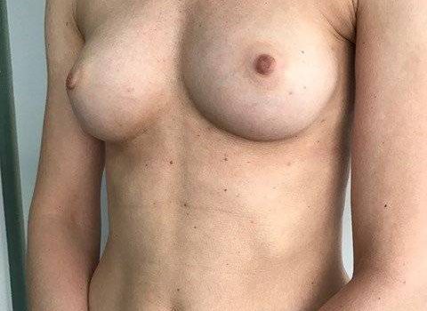 Borstvergroting met eigen vet na, Lipofilling borsten na