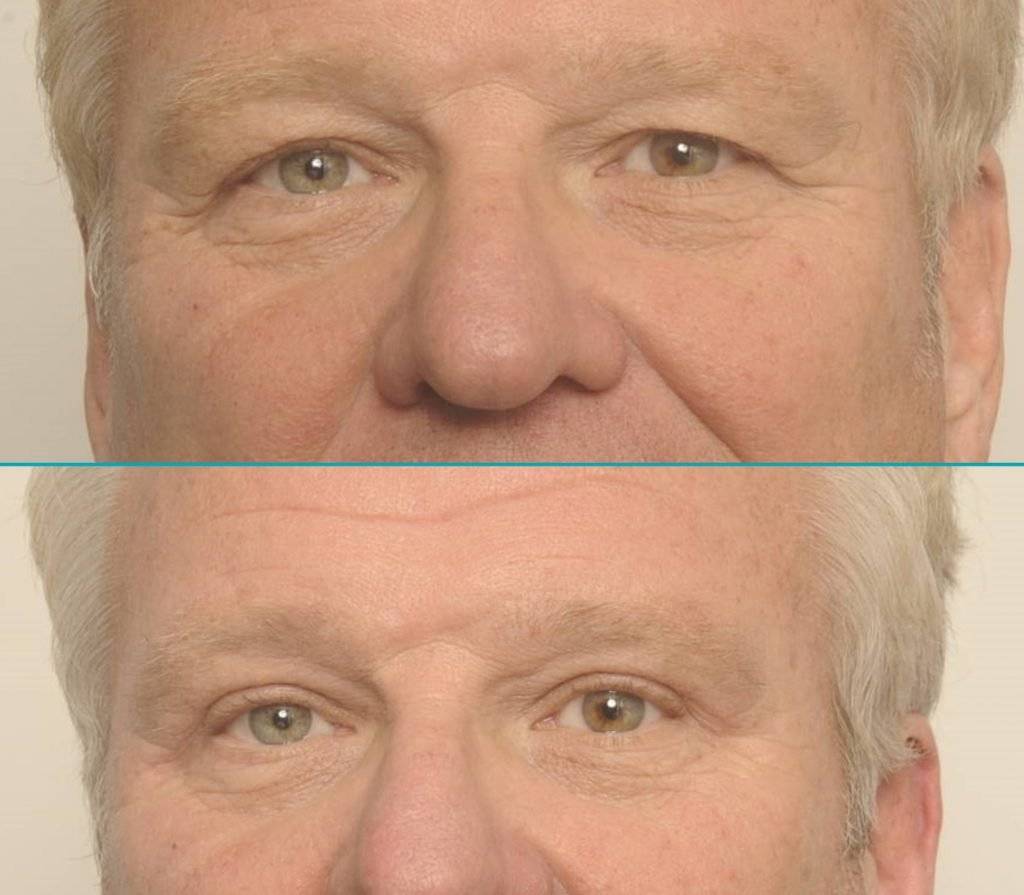 Resultaat behandeling wenkbrauwlift - Fred