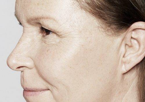 Katrina 54 jaar - Restylane Skinboosters na