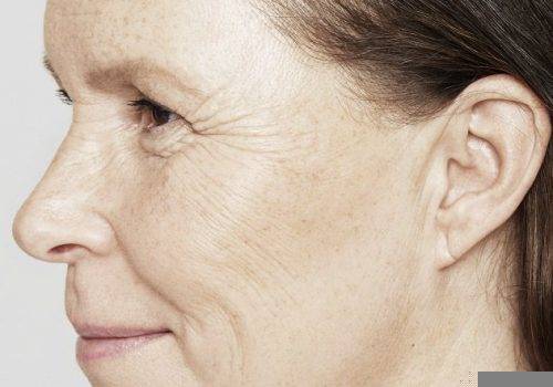 Katrina 54 jaar - Restylane Skinboosters voor