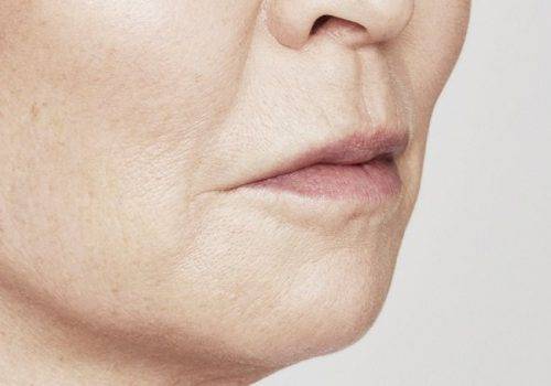 Marie - Lippen opvullen - Na