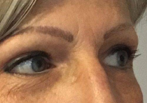Renata - 51 jaar - na bovenooglidcorrectie - drs Gerd Fabré - zij aanzicht