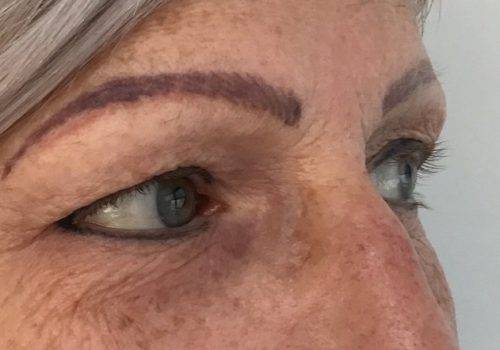 Renata - 51 jaar - voor bovenooglidcorrectie - drs Gerd Fabré - zij aanzicht