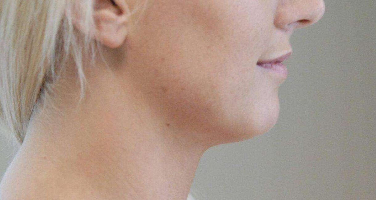liposuctie hals