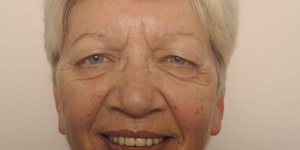 Ooglidcorrectie - Corry voor