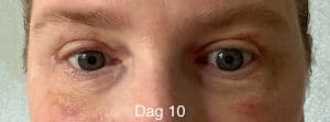 Herstel na een ooglidcorrectie - dag 10