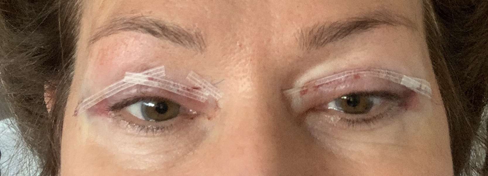 Herstel na een ooglidcorrectie in beeld | ABC Clinic