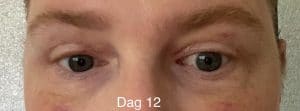 Herstel ooglidcorrectie - dag 12