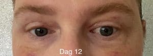 Herstel ooglidcorrectie - dag 12