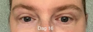 Herstel ooglidcorrectie - dag 16