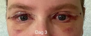 Herstel ooglidcorrectie - dag 3