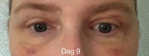 Herstel ooglidcorrectie - dag 9