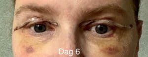 Herstellen na een ooglidcorrectie - dag 6