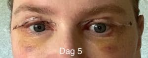 Ooglidcorrectie herstel - dag 5