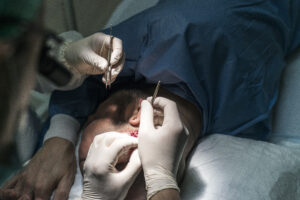 Haartransplantatie Arjan Benning - haartjes verwijderen pincet
