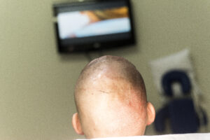 Haartransplantatie Arjan Benning - film kijken tijdens de fue-ingreep