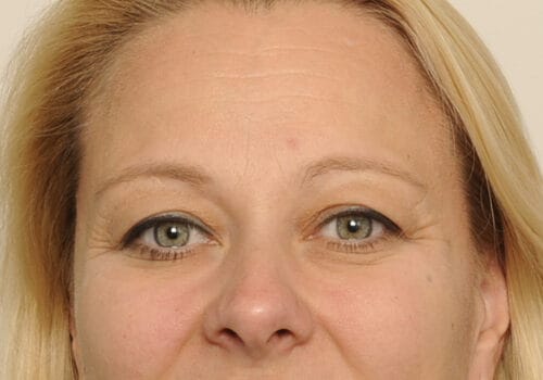 Ooglidcorrectie voor Linda