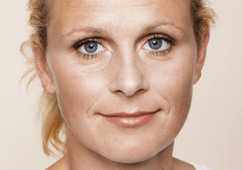 Wallen onder de ogen fillers - injectables voor