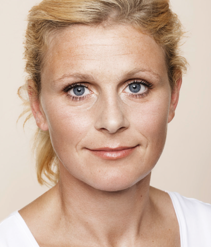 Wallen onder de ogen fillers - injectables voor