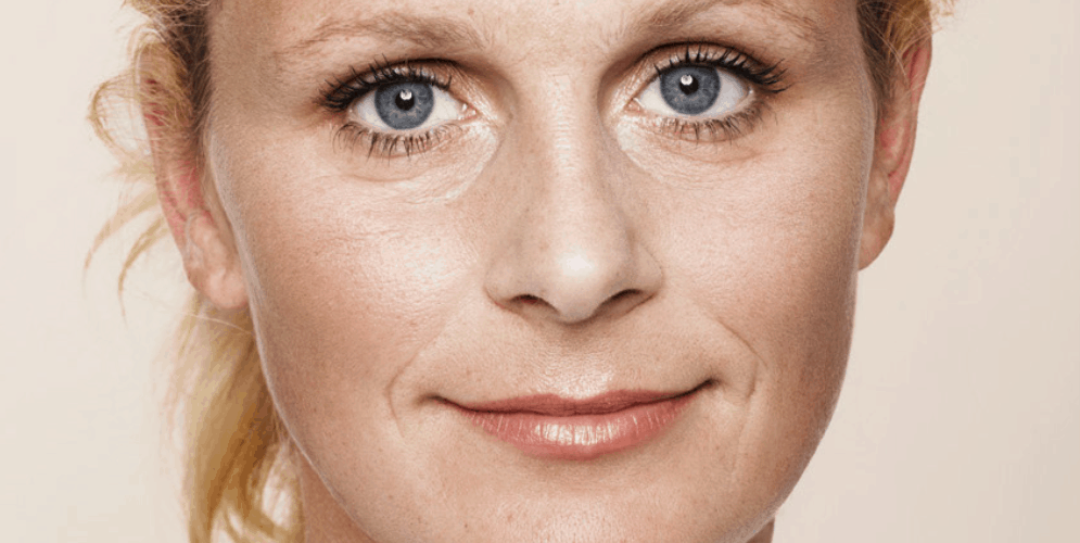 Wallen onder de ogen fillers - injectables voor