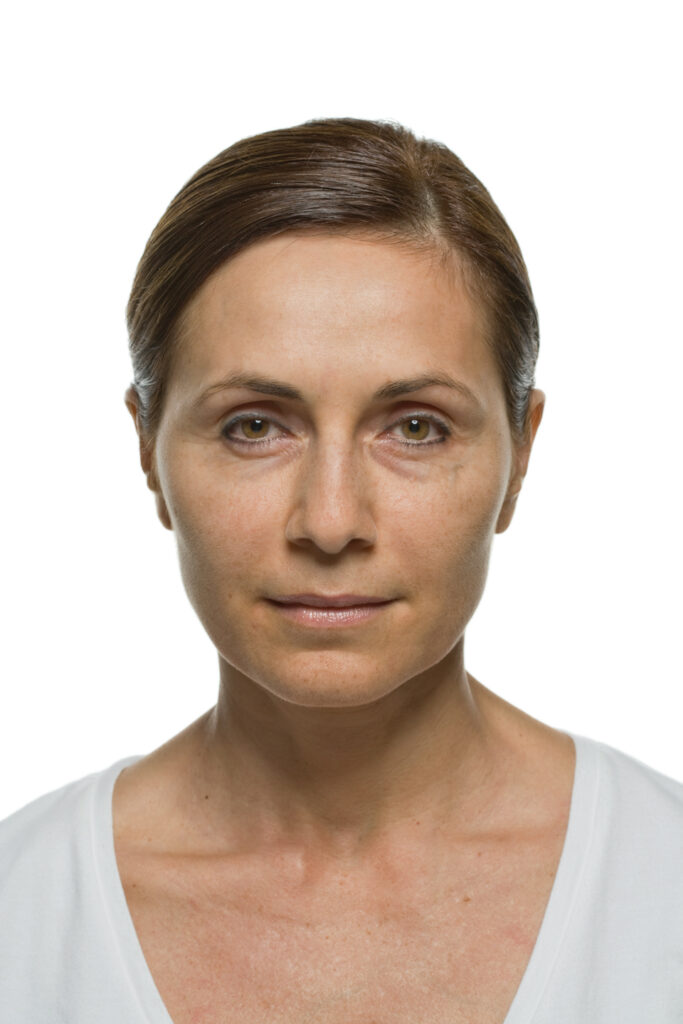liquid facelift na Carla
