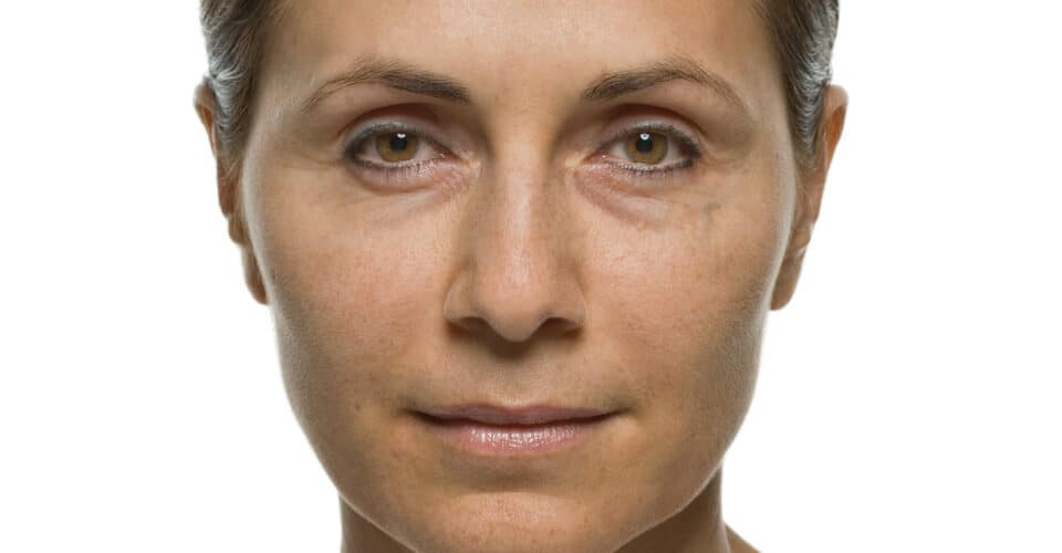 liquid facelift na Carla