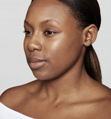 Fronsrimpel na Botox Azzalure - Sally