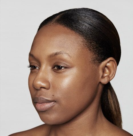 Fronsrimpel na Botox Azzalure - Sally