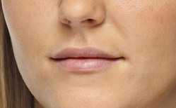 Lip opvullen na - lip fillers - injectables