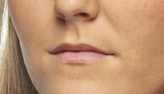 Volume in lip voor - lippen opvullen - lip fillers - injectables