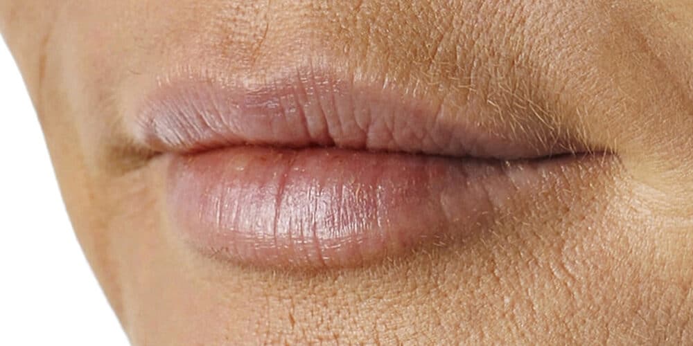 Lip smoothie na foto - Skinboosters lippen