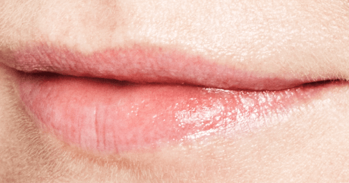 Lipopvulling Jessica na Restylane filler - lip fillers - injectables