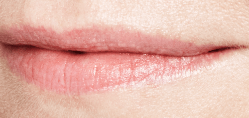 Lipopvulling Jessica voor Restylane filler - lip fillers - injectables