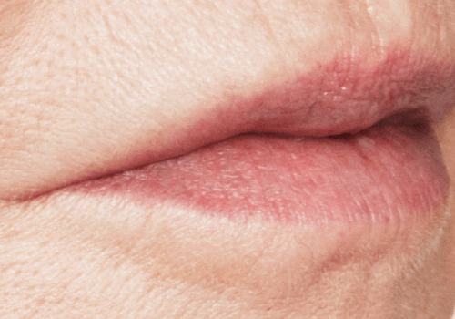 Lippen opvullen Marie na - Restylane - lip fillers - injectables