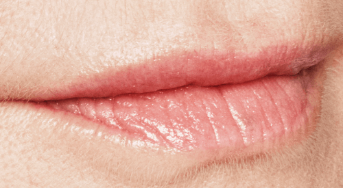Lippen opvullen - Restylane na - lip fillers - injectables