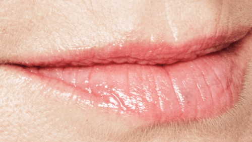 Lippen opvullen - Restylane voor - lip fillers - injectables