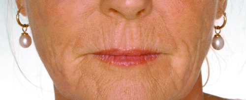 Lippen opvullen dame voor - lip fillers - injectables