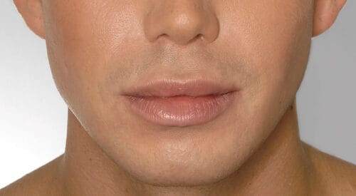 Fillers lippen, incl. gratis consult