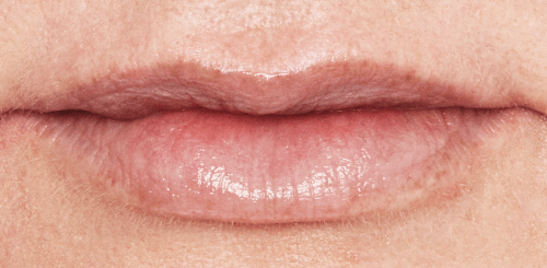 Lippen opvullen na - Restylane lippen - Sofia - lip fillers - injectables