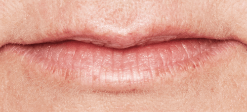 Lippen opvullen voor - Restylane lippen - Sofia - lip fillers - injectables