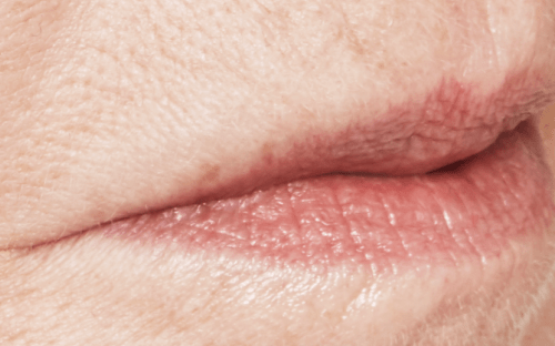 Lippen volume Marie voor - Restylane - lip fillers - injectables
