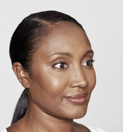Traandal of traangoot na fillers - injectables - Restylane Vanessa