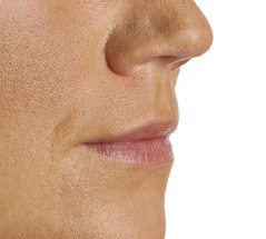 Volume in lip voor - lip fillers - injectables