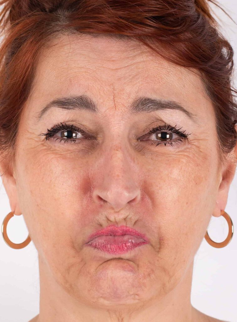 putjes kin, Botox kin voor, overactieve kin, baby botox, mini botox
